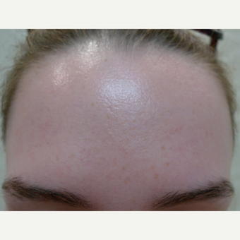 Acne treatments with peels after 3670365