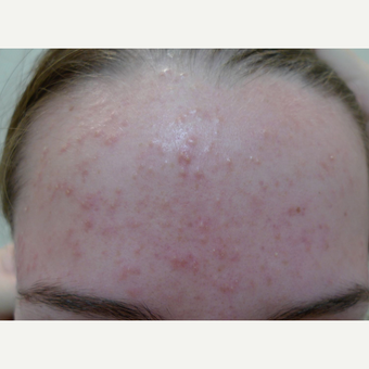 Acne treatments with peels before 3670365