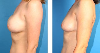 Breast Implant Revision after 562113