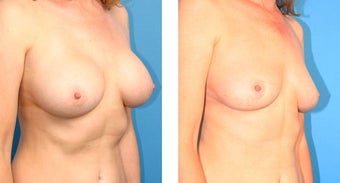 Breast Implant Revision 562113