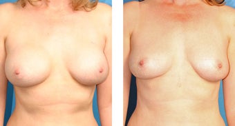 Breast Implant Revision before 562113