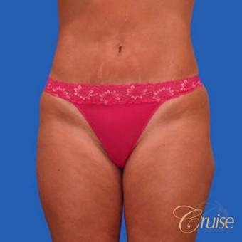 37 year old woman treated with a Tummy Tuck Revision after 3584920