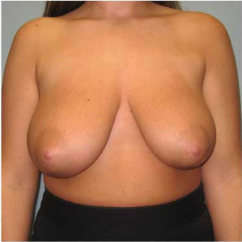 25 year old woman treated with Breast Reduction before 3468137