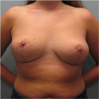 25 year old woman treated with Breast Reduction after 3468137