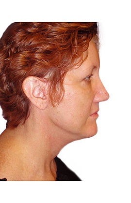 Rhinoplasty, closed technique with osteotomies after 401064