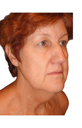 Rhinoplasty, closed technique with osteotomies 401064