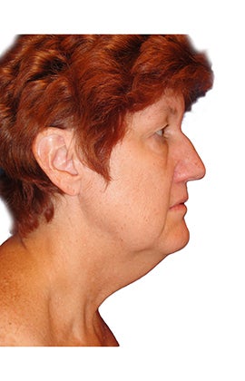 Rhinoplasty, closed technique with osteotomies before 401064