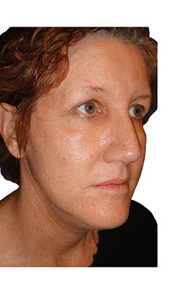 Rhinoplasty, closed technique with osteotomies 401064