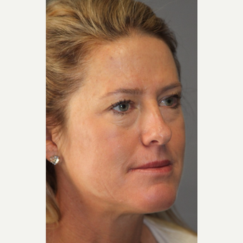 35-44 year old woman treated with Cheek Augmentation before 3141463