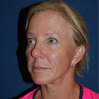 54 year old woman treated with Brow Lift after 3036699