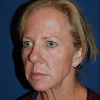 54 year old woman treated with Brow Lift before 3036699