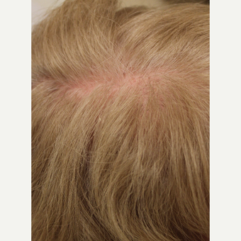 65-74 year old woman treated with PRP for Hair Loss before 3385483
