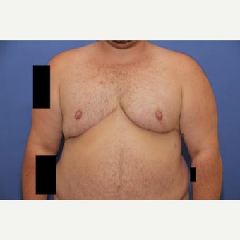 30 year old trans man treated with FTM Chest Masculinization Surgery after 2096369