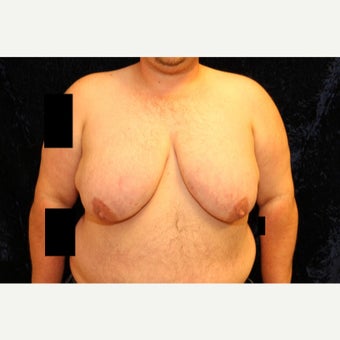30 year old trans man treated with FTM Chest Masculinization Surgery before 2096369