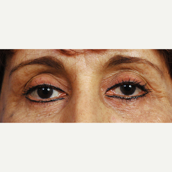 45-54 year old woman treated with Eyelid Surgery after 3453927