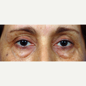 45-54 year old woman treated with Eyelid Surgery before 3453927