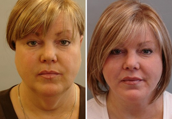 Mid Face Cheek Lift before 1360158