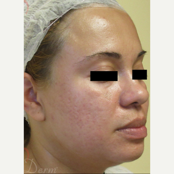 25-34 year old woman treated with Acne Scars Treatment after 3375124