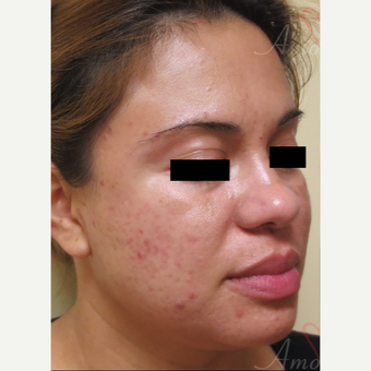 25-34 year old woman treated with Acne Scars Treatment before 3375124