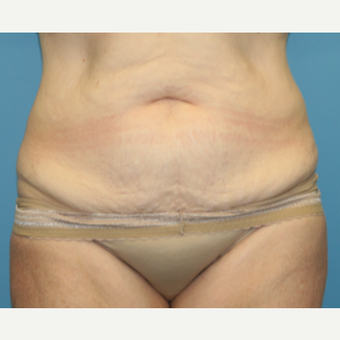 54 year old woman treated with Tummy Tuck before 3582374