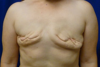 42 Year Old Delayed Breast Reconstruction with Expanders and Alloderm before 1263124