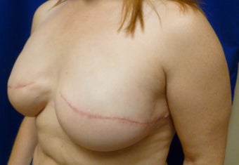 42 Year Old Delayed Breast Reconstruction with Expanders and Alloderm 1263124