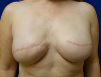 42 Year Old Delayed Breast Reconstruction with Expanders and Alloderm after 1263124