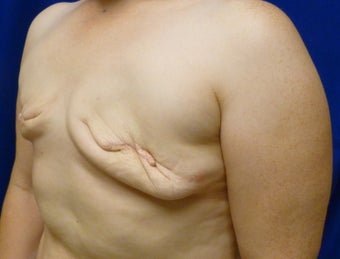 42 Year Old Delayed Breast Reconstruction with Expanders and Alloderm 1263124