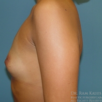 25-34 year old woman treated with Breast Augmentation before 1713686