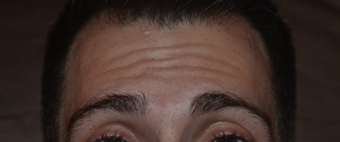 30 Year Old Male Treated For Forehead Lines before 1380335