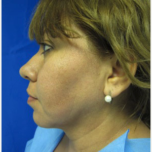 Chin Implant before 3164309