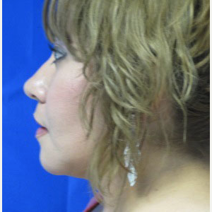 Chin Implant after 3164309