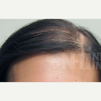 18-24 year old woman treated with Scalp Micropigmentation before 3129002