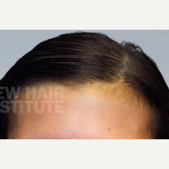 18-24 year old woman treated with Scalp Micropigmentation after 3129002