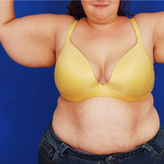 35-44 year old woman treated with Arm Lift Brachioplasty before 3741320