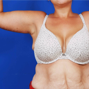 35-44 year old woman treated with Arm Lift Brachioplasty after 3741320