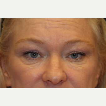 45-54 year old woman treated with Belotero before 3502573