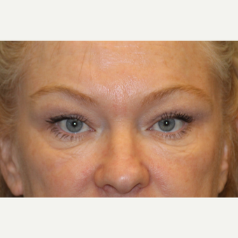 45-54 year old woman treated with Belotero after 3502573