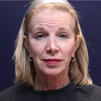 Immediately Post Sculptra to temples and mid-face before 3187642
