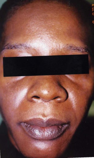 African American Woman 30 to 40 years old with hyperpigmentation after 754281