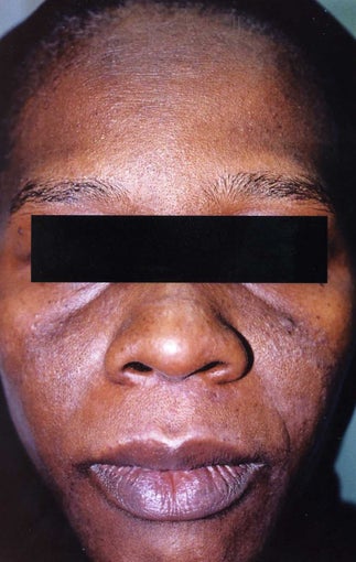 African American Woman 30 to 40 years old with hyperpigmentation before 754281