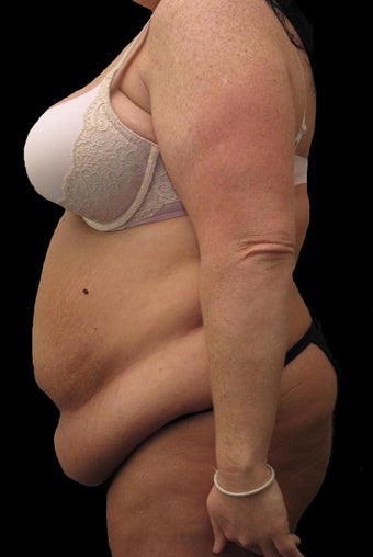 34 year old woman treated with Body Lift 2637453