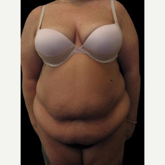 34 year old woman treated with Body Lift before 2637453