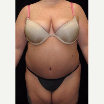 34 year old woman treated with Body Lift after 2637453
