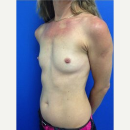Breast Augmentation before 3744108