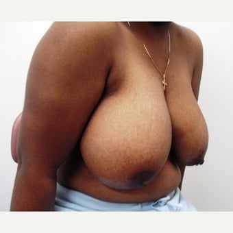 25-34 year old woman treated with Breast Reduction before 1540303