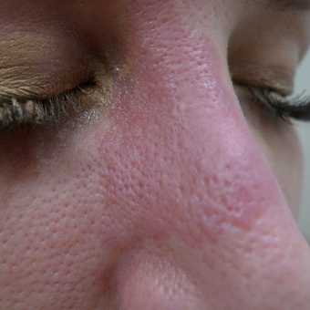 Port wine stain treatments before 3033848