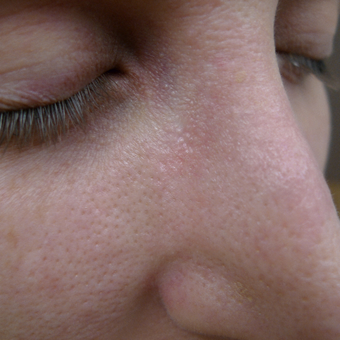 Port wine stain treatments after 3033848