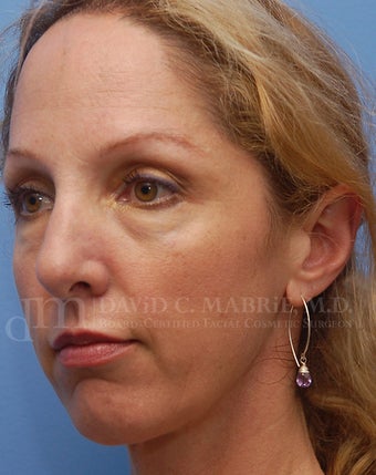 Cheek Dermafillers, Eye Dermafillers, Facial Dermafillers 238421