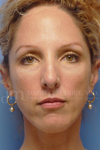 Cheek Dermafillers, Eye Dermafillers, Facial Dermafillers after 238421